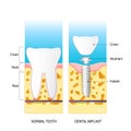 Dental implant. Vector diagram for medical use Royalty Free Stock Photo