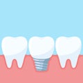 Dental implant vector illustration Royalty Free Stock Photo