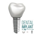 Dental Implant Vector. Molar Human Teeth. Dental Clinic Stomatology Flyer. Realistic Isolated Illustration Royalty Free Stock Photo