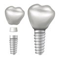 Dental Implant Vector. Implant Structure. Crown, Abutment, Screw. Realistic Isolated Illustration Royalty Free Stock Photo