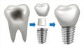 Dental Implant Vector. Tooth With Caries. Health Tooth Implant. Dental Clinic Stomatology Flyer. Realistic Isolated