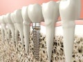 Dental implant Royalty Free Stock Photo