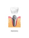 Dental Implantation Prosthetics Composition