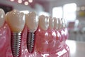 Dental implantation, teeth with implant screw, .AI generative