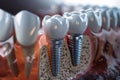 Dental implantation, teeth with implant screw, .AI generative