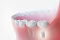 Dental implantation, teeth with implant screw