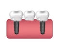 Dental implants, bridge construction, prosthetics 3D realistic style. Dentistry, healthy teeth concept. Vector