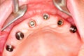 Dental implants with gingival cuffs