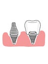 Dental implants and gingival illustration cartoon icon white colors