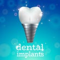 Dental implants 1