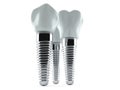 Dental implants