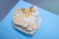 Dental implants. Restore lost teeth. Dental bridge on the jaw mockup Royalty Free Stock Photo