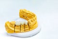 Dental implants. Restore lost teeth. Dental bridge on the jaw mockup. Dental laboratory Royalty Free Stock Photo