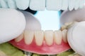 Dental implants supported overdenture.