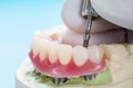 Dental implants supported overdenture. Royalty Free Stock Photo