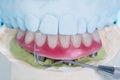 Dental implants supported overdenture. Royalty Free Stock Photo