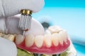 Dental implants supported overdenture.