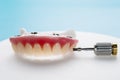 Dental implants supported overdenture. Royalty Free Stock Photo