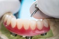 Dental implants supported overdenture. Royalty Free Stock Photo