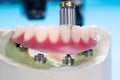 Dental implants supported overdenture.