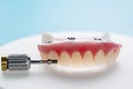 Dental implants supported overdenture. Royalty Free Stock Photo