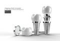 Dental Implants surgery concept Pen Tool Created Clipping Path Included in JPEG Easy to Composite Royalty Free Stock Photo