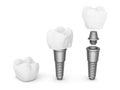 Dental implants