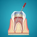 Dental injection in cutaway