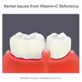 Dental Issues from Vitamin C Deficiency. Illustration