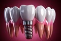 Dental makeover realistic teeth implant showcases advancements in modern dental treatment
