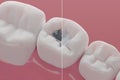 Dental mecury amalgam and composite filling