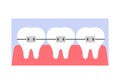 Dental metal braces for straightening teeth, diagram structure of gum