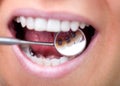 Dental mirror showing lingual braces Royalty Free Stock Photo