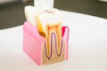 Dental model anatomy of the tooth cross-section dentist concept for education Royalty Free Stock Photo