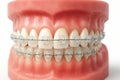 Dental model with clear ceramic braces on upper and lower teeth Royalty Free Stock Photo