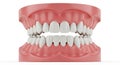 Dental model displaying teeth alignment Royalty Free Stock Photo