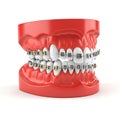 Dental model with metal braces on teeth Royalty Free Stock Photo