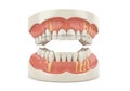 Dental model showing upper and lower jaws with gum inflammation and decayed teeth Royalty Free Stock Photo