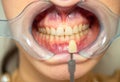 Dental mouth spreader, before teeth whitening