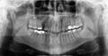 Dental orthopantomogram