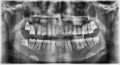 Dental panaromic x-ray film