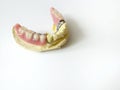 Dental partial denture in mandible