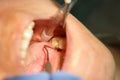 Dental patient getting her molar teeth and gums examined