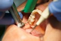 Dental patient getting her molar tooth cavity drilled