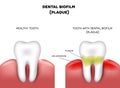 Dental plaque Royalty Free Stock Photo