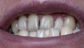 Dental plaque on man`s teeth caused by coffee residual