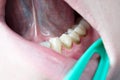 Dental plaque on teeth, caries, gingivitis, periodontitis, periodontal disease, tartar, professional oral hygiene, gingivitis