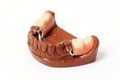 Dental plaster moulds, Dentures