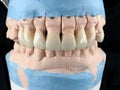 Dental porcelain prosthesis implant tooth in dental laboratory. Front view. Selective focus. Lower and upper jaw in