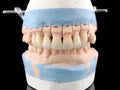 Dental porcelain prosthesis implant tooth in dental laboratory. Plaster model with all-ceramic bridge restoration